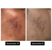 Load image into Gallery viewer, Turmeric Spot Treatment - Roller Ball